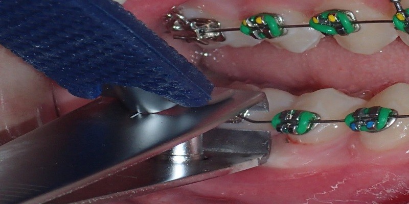 How to Cut Braces Wire Easily Using Nail Clippers