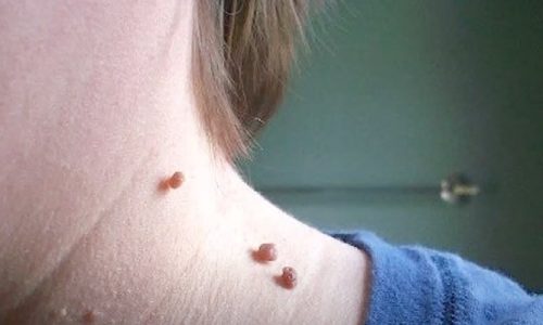 Are Warts And Skin Tags The Same?