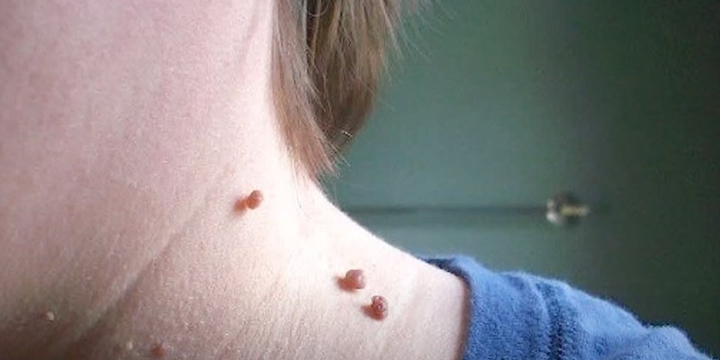 You are currently viewing Are Warts And Skin Tags The Same?