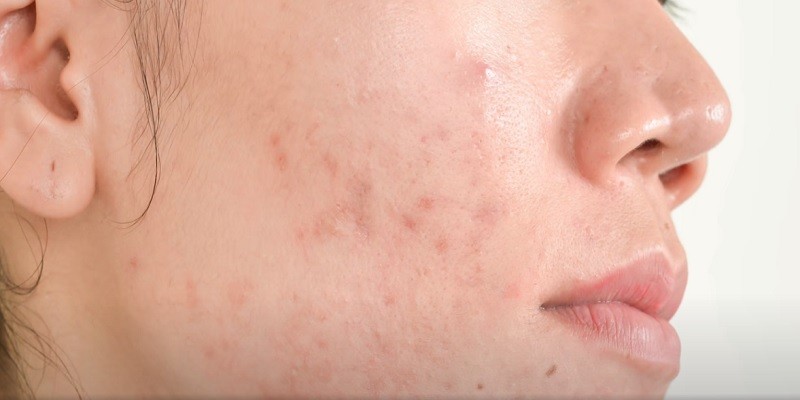 Does Celsius Cause Acne Breakouts