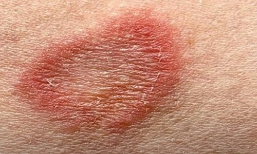 Does Hand Sanitizer Kill Ringworm On Skin?