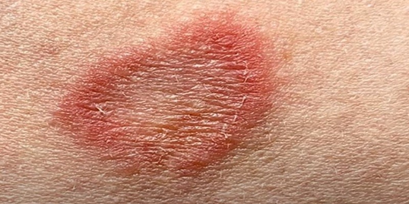 You are currently viewing Does Hand Sanitizer Kill Ringworm On Skin?