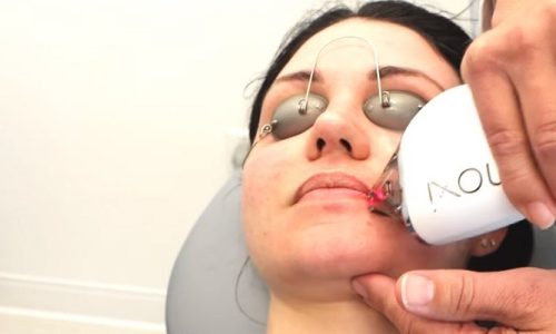 Does Moxi Laser Tighten Skin?