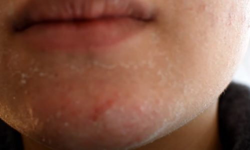 Does Tretinoin Make Your Skin Peel?