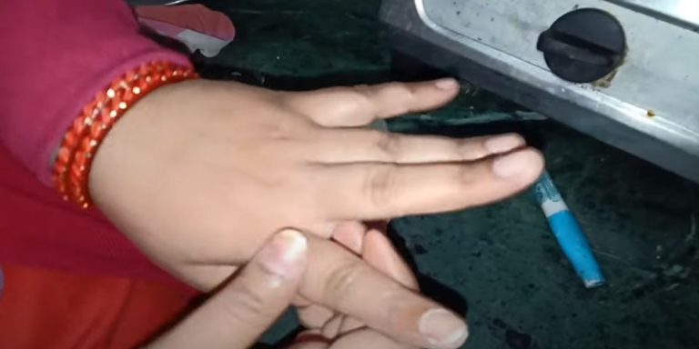 How To Remove White-Out From Skin
