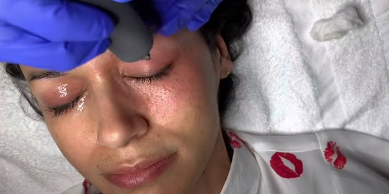 You are currently viewing What Is Fibroblast Skin Tightening?