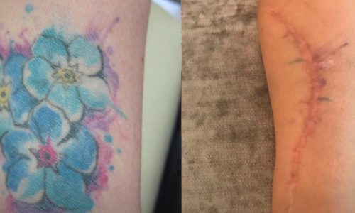 Can You Get Tattoos Before Surgery?