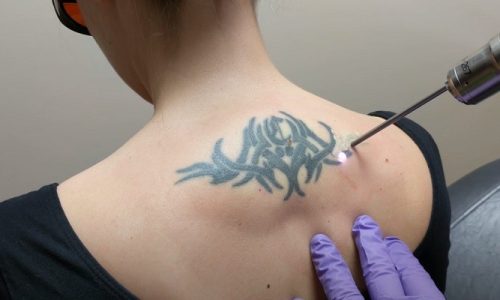 Does Laser Tattoo Removal Leave Scars?