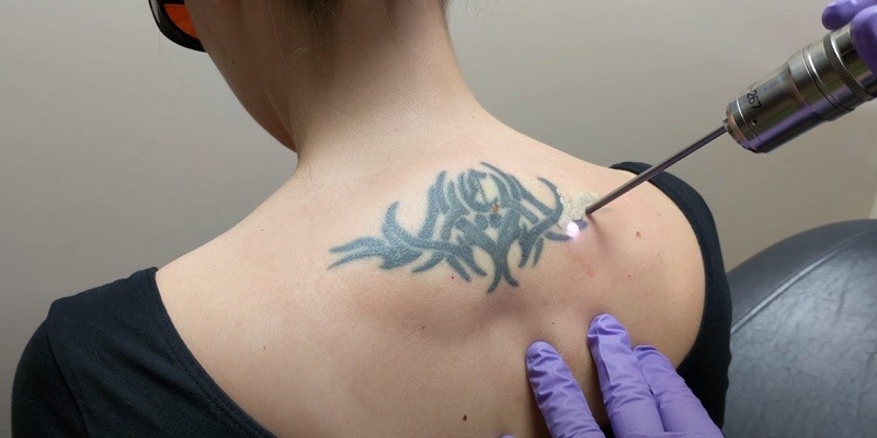 Does Laser Tattoo Removal Leave Scars