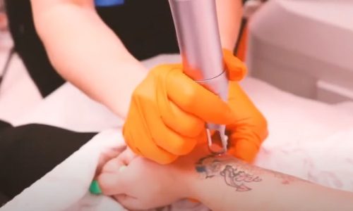 Does Tattoo Removal Leave Scars?