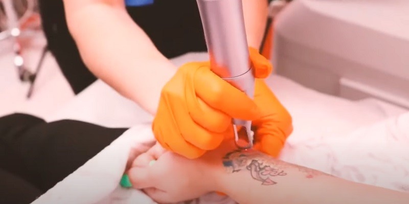 Does Tattoo Removal Leave Scars