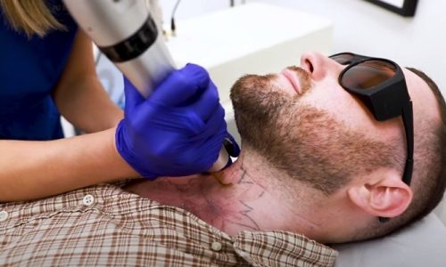 How To Become A Laser Tattoo Removal Technician?